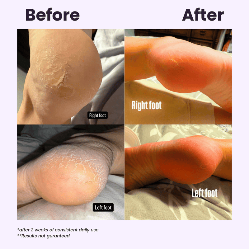 Before and after comparison of feet after using urea 40 cream