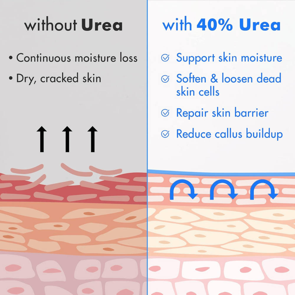 Comparison of skin conditions with and without urea cream, showing benefits of urea cream on skin health.